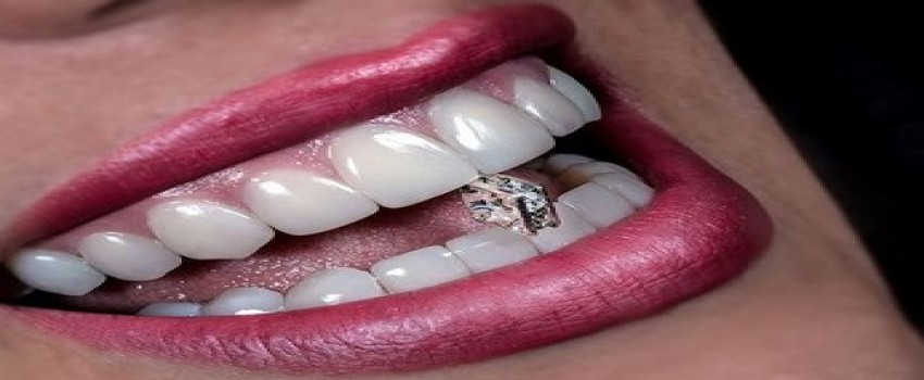 برند کامپوزیت چقدر در کیفیت درمان تاثیر دارد؟